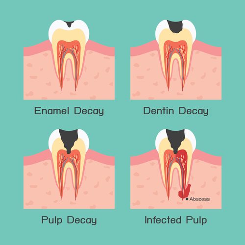 How To Treat A Tooth Abscess - Youtube