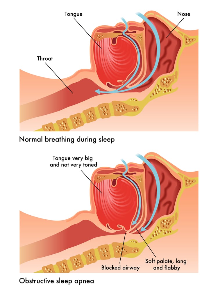 Diagram Showing Obstructive Sleep Apnea vs. Normal Breathing 