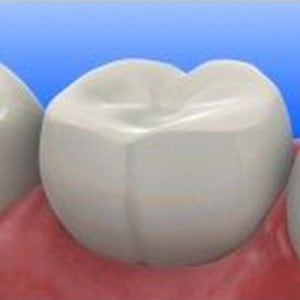 Composite Fillings