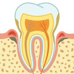 Root Canal Treatment